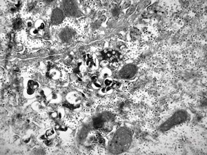 M,16y. | Wilson disease susp.